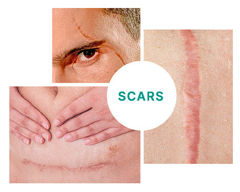 Lsi Sodermix Scars Cream 30ml كريم للندب والآثار